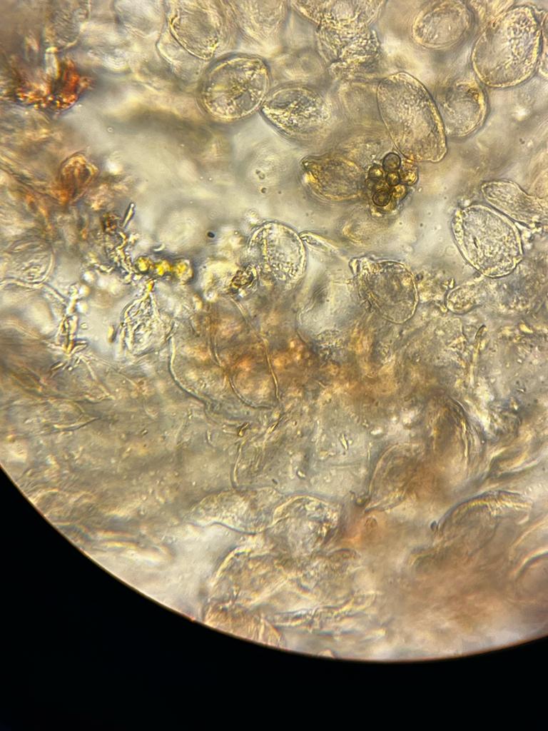 Cromoblastomicosis
 #FungalDiseaseAwarenessWeek
 #ThinkFungus
Día 5
Caso de colegas del Hospital del Milagro, Salta, Argentina