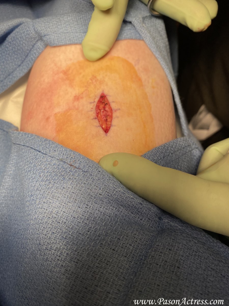 PasonActress's tweet photo. #BasalCellSkinCancer #MOHsSurgery on right shin #SkinCancer #FairSkin #NaturalRedheads #Redheads #Gingers #Health #SkinCare Great MOHs Surgeon Dr. David Beynet! Thank u! If something doesn't look normal or isn't healing go to ur Dr. &amp; get it checked! #Pason #PasonActress https://t.co/ewoS7u4G1q