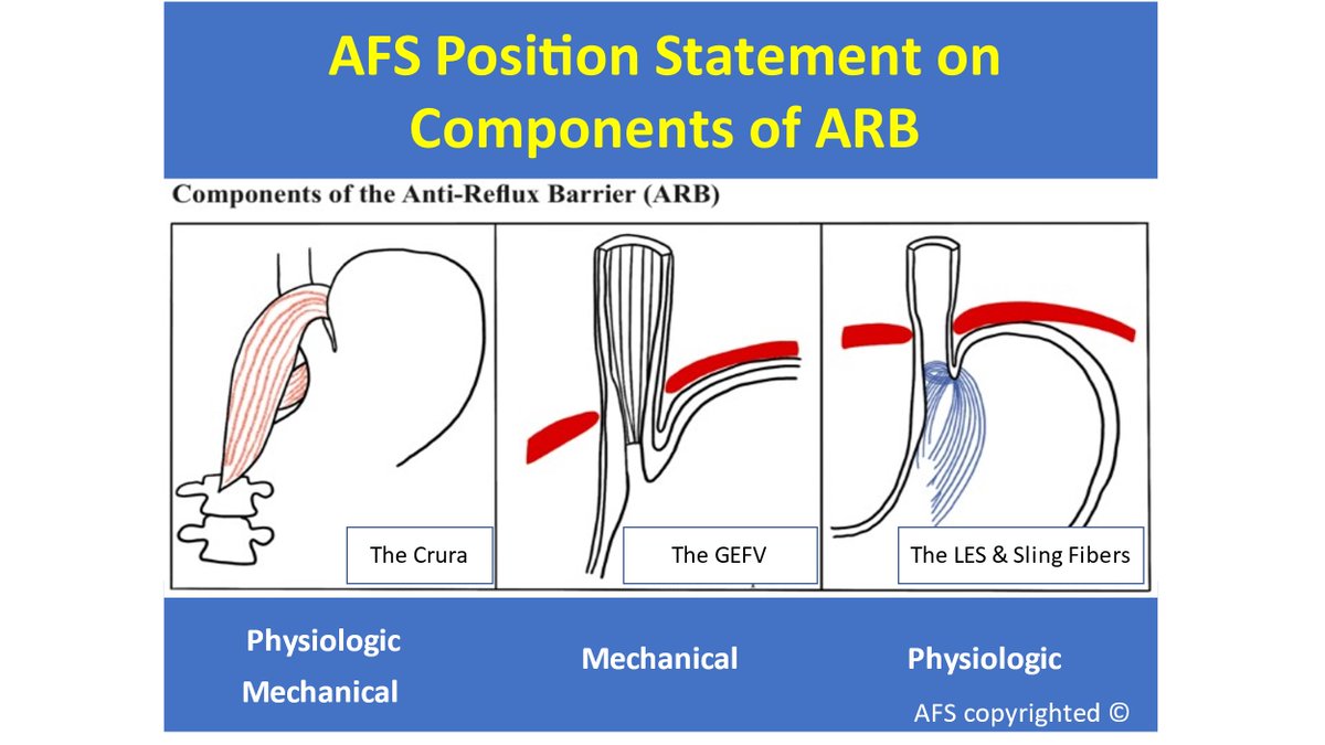 The American Foregut Society (@foregutsociety) on Twitter photo A brand new position statement by the AFS on the components of the antireflux barrier (ARB). The 3 components include 1) the crura, 2) the gastroesophageal flap valve, and 3) the lower esophageal sphincter and its sling fibers. <a href="/foregut_journal/">Foregut Journal</a> <a href="/EuropeanForegut/">European Foregut Society</a> A brand new position statement by the AFS on the components of the antireflux barrier (ARB). The 3 components include 1) the crura, 2) the gastroesophageal flap valve, and 3) the lower esophageal sphincter and its sling fibers. <a href="/foregut_journal/">Foregut Journal</a> <a href="/EuropeanForegut/">European Foregut Society</a>