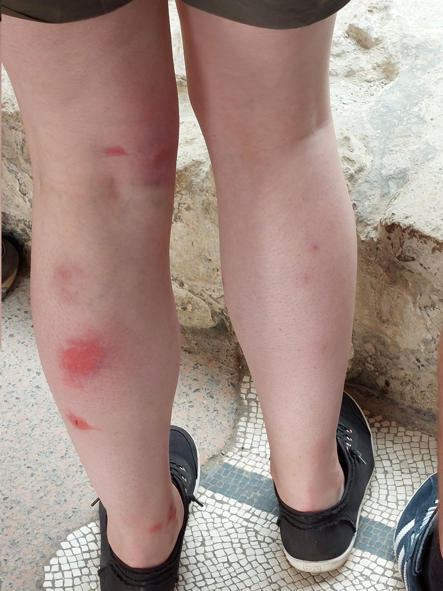 Sturdygirl0803's tweet photo. #BiteWatch update. Saw this at Herculaneum today, thought someone's got it worse than me, poor girl. In fact, have seen many bitten legs, so it's not just me. https://t.co/XJ13skJV6F