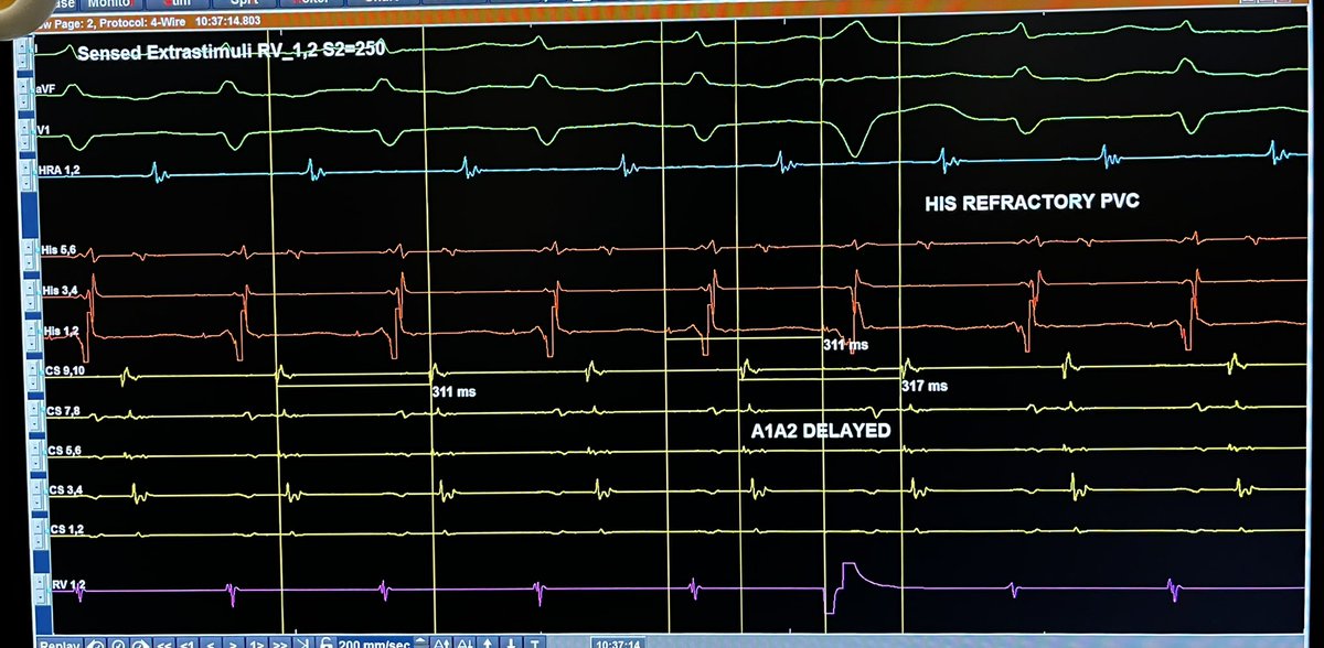 PMA Maneuver Entry with a BONUS: ErPVC showed extranodal response (H1H2 - A1A2 < 35) AND HRPVC delayed subsequent A, showing post-excitation and confirmation of a #decremental concealed #pathway @Ashit_EPS @forkknifecab_EP @NotYourAvg_PR twitter.com/forkknifecab_e…