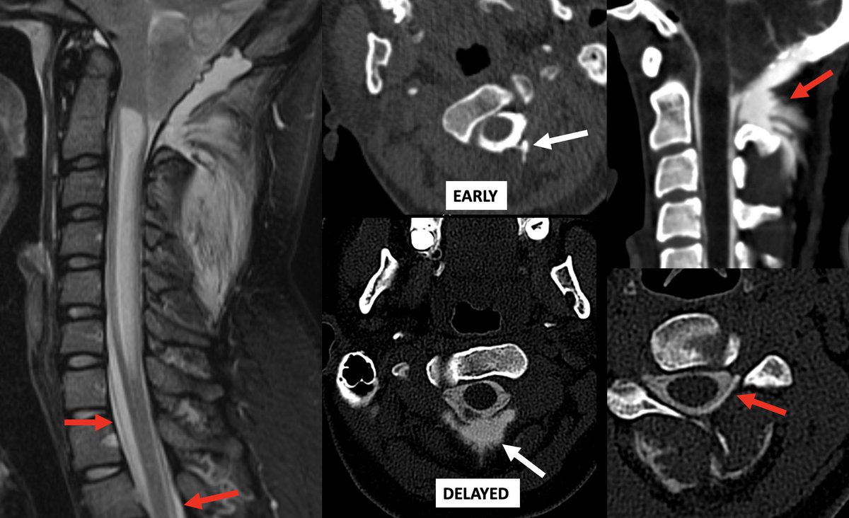 We know the false localizing sign in #SIH posterior to C2 due to anatomic communication of the epidural space and posterior spinal soft tissues. This patient has a "reverse" false localizing sign, presenting after suboccipital crani with leaking duraplasty into epidural space!