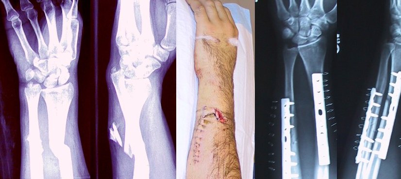 DrJustinAlbert1's tweet photo. Broken fixed arm https://t.co/9j0onXWUdj