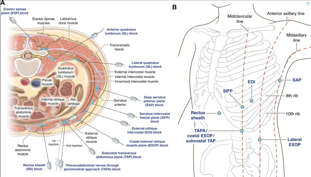 Patrick Wong (@patrickwongmd) on Twitter photo Great editorial by <a href="/jon_bailey_anes/">Jon Bailey MD MSc FRCPC EDRA 🇨🇦🧗🏄♂️</a> & <a href="/Ropivacaine/">Dr. Vishal Uppal MBBS, FRCA 🇨🇦🇮🇳🏴</a> in this month's <a href="/CJA_Journal/">CJA - Canadian Journal of Anesthesia</a> on yet another set of alphabets in the fascial plane block soup Great editorial by <a href="/jon_bailey_anes/">Jon Bailey MD MSc FRCPC EDRA 🇨🇦🧗🏄♂️</a> & <a href="/Ropivacaine/">Dr. Vishal Uppal MBBS, FRCA 🇨🇦🇮🇳🏴</a> in this month's <a href="/CJA_Journal/">CJA - Canadian Journal of Anesthesia</a> on yet another set of alphabets in the fascial plane block soup