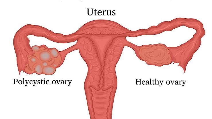 Para wanita harus tahu ini.

Semakin banyak mereka mengkonsumsi minuman manis, semakin besar risiko mereka mengalami PCOS. Banyak yang infertil gara-gara itu.

Titipkanlah ke kaum wanita di DPR untuk perjuangkan agar batas jumlah gula dalam produk 🥤🧋🧃 lebih diturunkan.