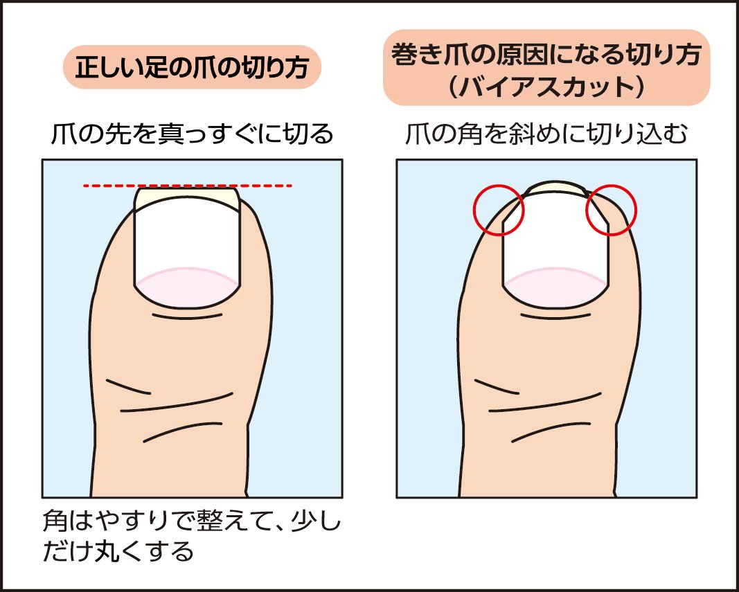巻き爪 Twitter Search Twitter