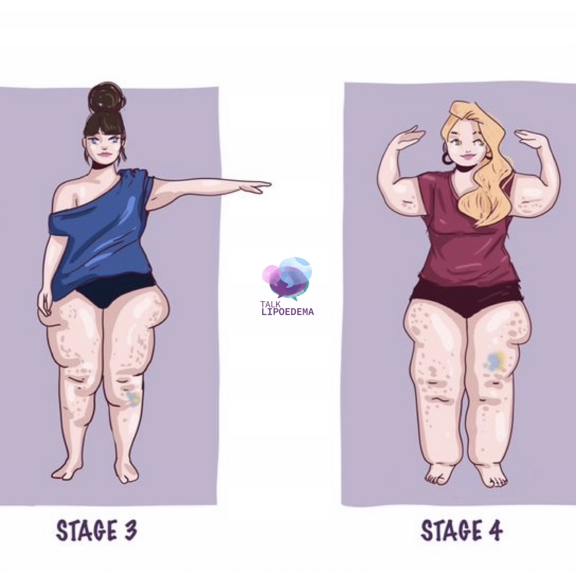 Do you have #Lipoedema? Check out these  common symptoms: Large shaped legs, cuffs around ankles, Swollen legs that easily bruise + are painful to touch, Excess tissue gathered around knees and on inner thighs, Size doesn’t reduce with diet or exercise?? #talklipoedema #lipoe ...