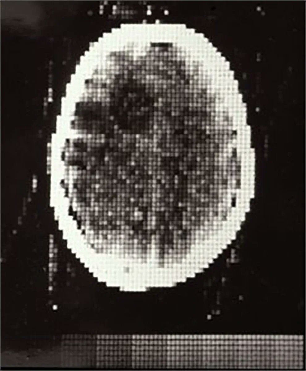 The first CT scan of a patient's brain was taken on this day in 1971.

The images from these scans took over 2 hours to be processed by algebraic reconstruction techniques on a large computer.