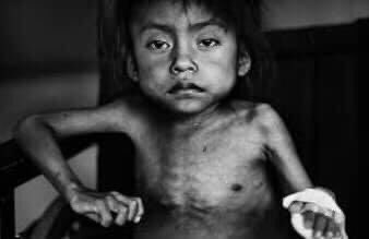 MarlonMezaTeni's tweet photo. FELIZ DÍA DEL NIÑO GUATEMALTECO.

Guatemala es el sexto país del mundo en desnutrición infantil. https://t.co/dzW5RYTthA