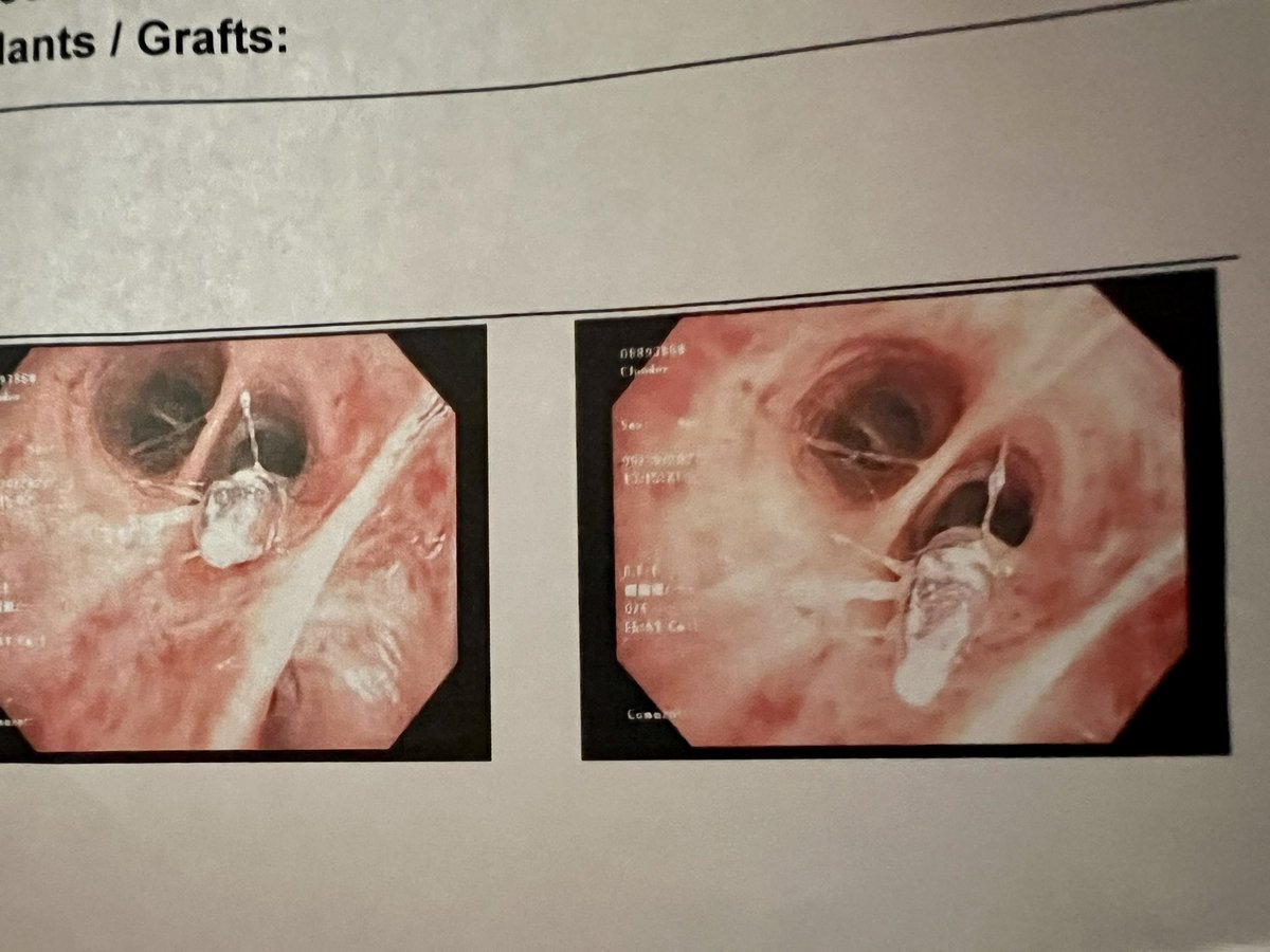 csclauder's tweet photo. Ok here’s what happened: I originally thought I swallowed a nail; alas, I *aspirated* a nail, which they found out after x-rays at the ER. 🧵 1/? https://t.co/KYEGPleOTD