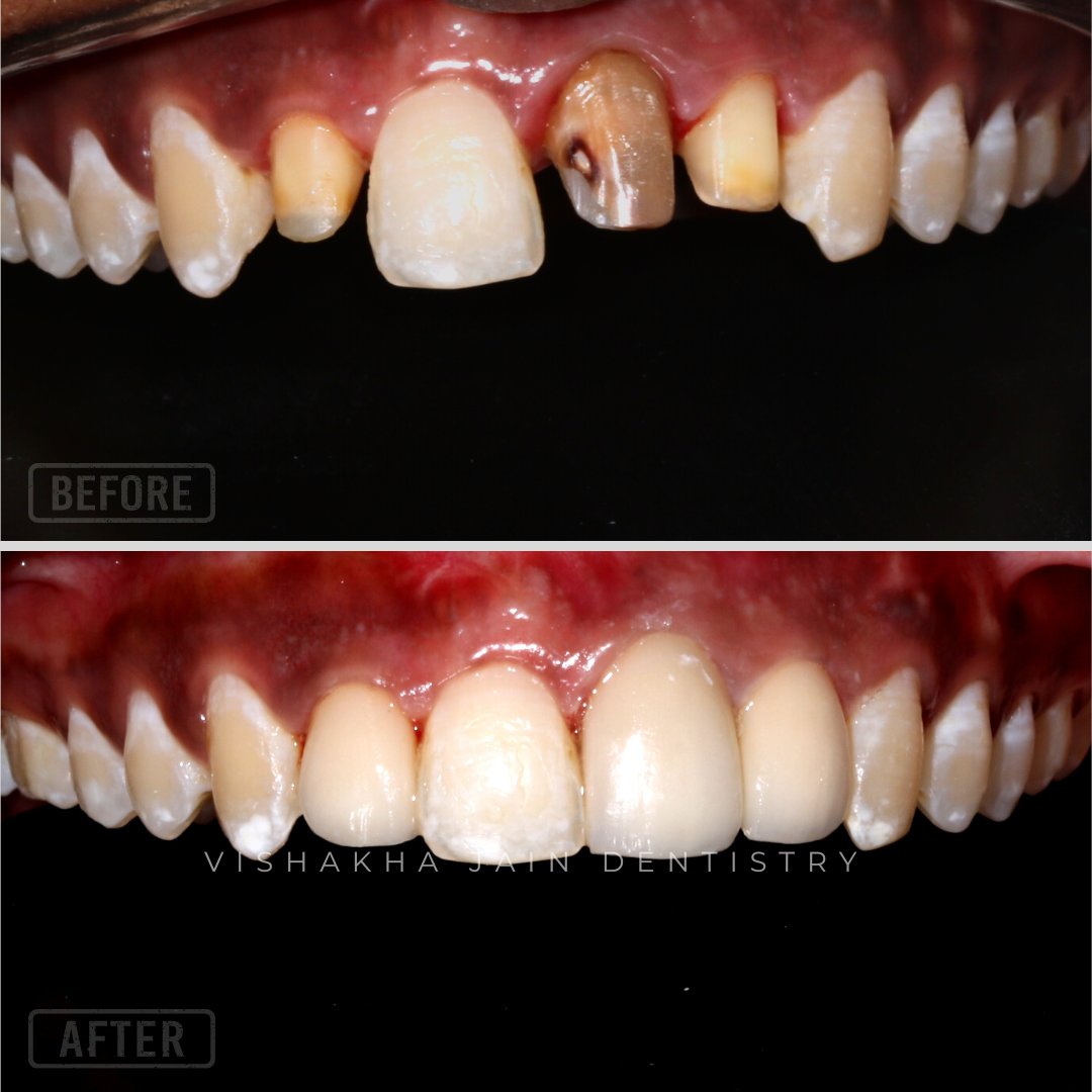 ClinicIndore's tweet photo. There are two methods for performing dental restoration.
Crown and bridge are two methods for strengthening your teeth.

Contact us for free consultation!!

Visit- https://t.co/A5w4bu6Wyv
.
#DentalClinic #DentalHealth #KeepSmiling #Dentalcap #dentalcrown #Crowns https://t.co/lO1H2N4XRH