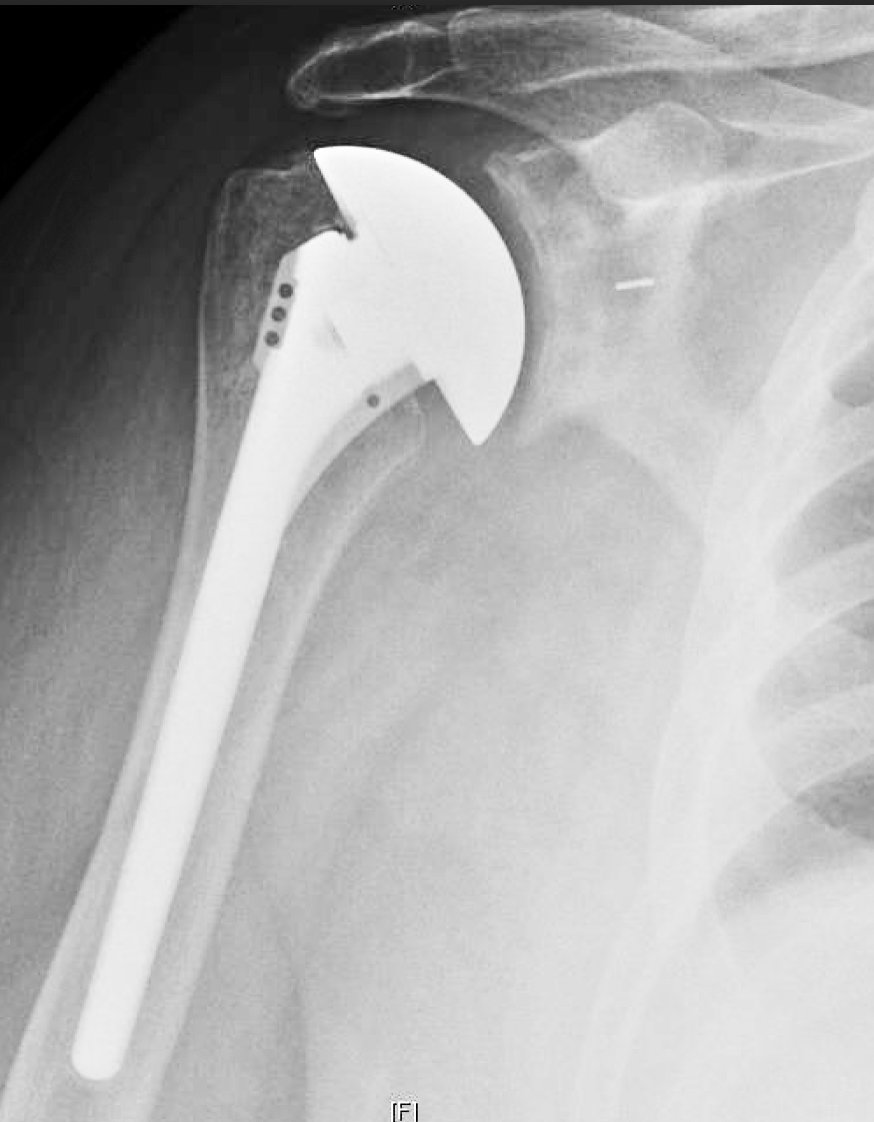 shoulderarth's tweet photo. Factors affecting the outcome of shoulder arthroplasty. https://t.co/UMPU2WBiTy https://t.co/7WDr395no1