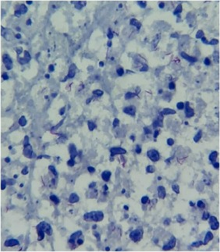 A 55-year-old male patient, from Mexico, rheumatoid arthritis: painful ulcer on the right lateral margin of the tongue &amp; weight loss. 

CT : micronodular infiltrates

🔬Ziehl-Neelsen tongue biopsy: ?
1/4

doi.org/10.1016/j.idcr…
#MedEd #IDtwitter #microbiology