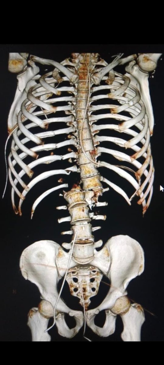 XrayProblems's tweet photo. Is it broken or just fractured?
#radiology #ctscan #radtech #xrayprobs https://t.co/VGZHwg7orr