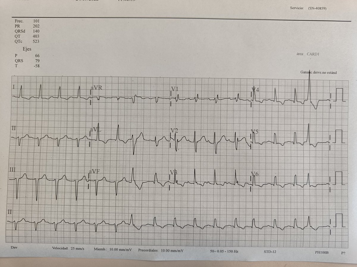 DaviddlCuevas's tweet photo. True trifascicular blockade🙅syncope+SCALP
@MaruanCarlos @brun_dav @EcgsOnly @ecgrhythms @ECGWeekly @ECGWeekly @DidlakeDW @ecg12com @ECGfan @12_Derivaciones @EkgHacks @ECGQuizzes @EF_Cardiaca @ekgpress @EkgHacks @The_Nanashi_O @ElectroSIAC1 @JElectrocardiol @hisclinics @SeanIre_ https://t.co/wKbzvHmQRM
