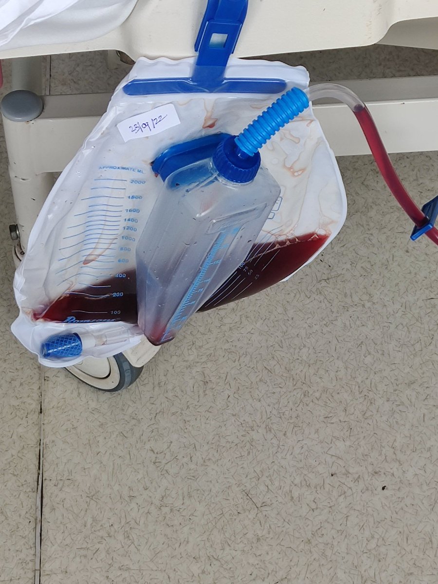 SekharRaghuram's tweet photo. Our young ICU registrars are counselled : this is hemoglobinuria, not hematuria,will settle, please don't panic and call at 2am #angiojet @BostonSciWDD #pharmacomechanicalthrombectomy #VTE #vascularsurgery @KDAHMumbai https://t.co/GM31CnMavN