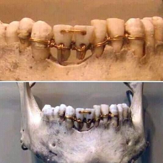 HistoryVibes2's tweet photo. Dental work found on a 4,000- year old mummy in ancient Egypt. https://t.co/o0MzOXhaxz