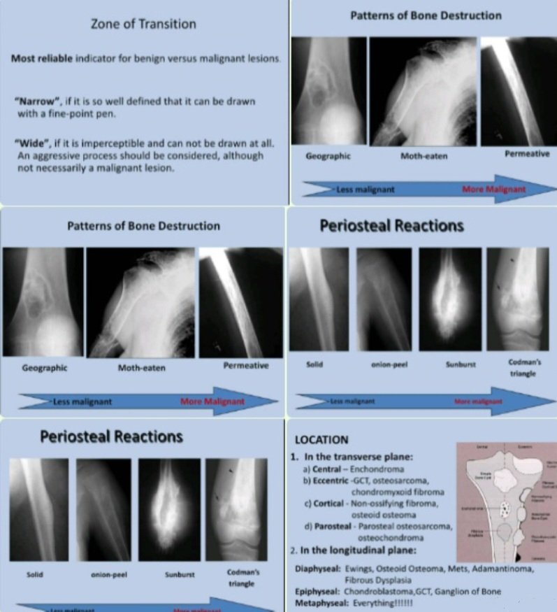 The radiographic approach to bone tumors: Analyzing in an organized manner👉attention to specific radiographic features: location,margins& transition zones, periosteal reaction patterns, mineralization,lesion size. ncbi.nlm.nih.gov/pmc/articles/P… And presence of soft tissue components