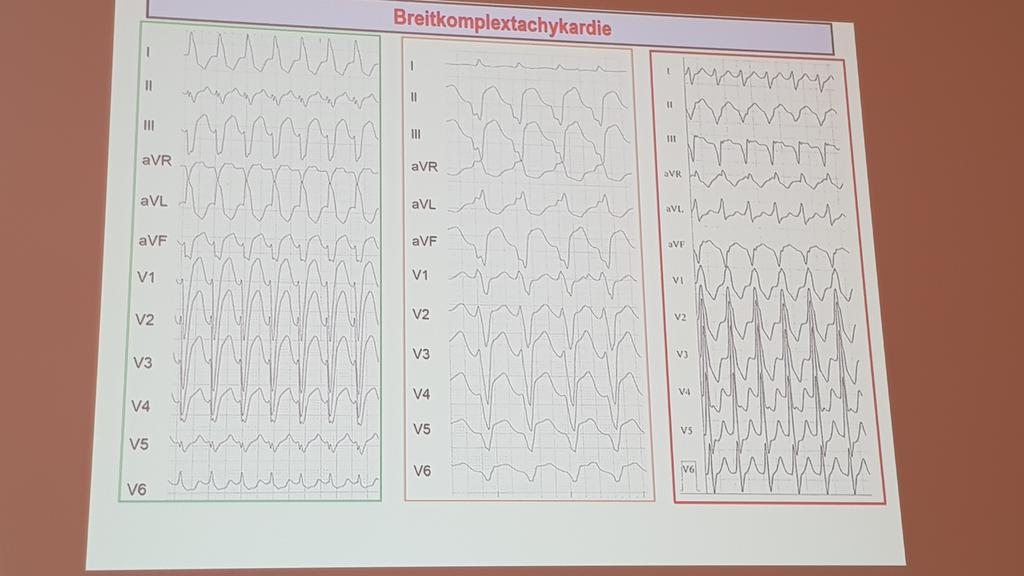 SamerMatar88's tweet photo. Prof. Antz aus Braunschweig erzählte uns über die breitkomplexe Tachykardien, die Diagnostik, Algorithmen und wichtige Tipps. 

#MGEKG https://t.co/v4LqCnCMEz