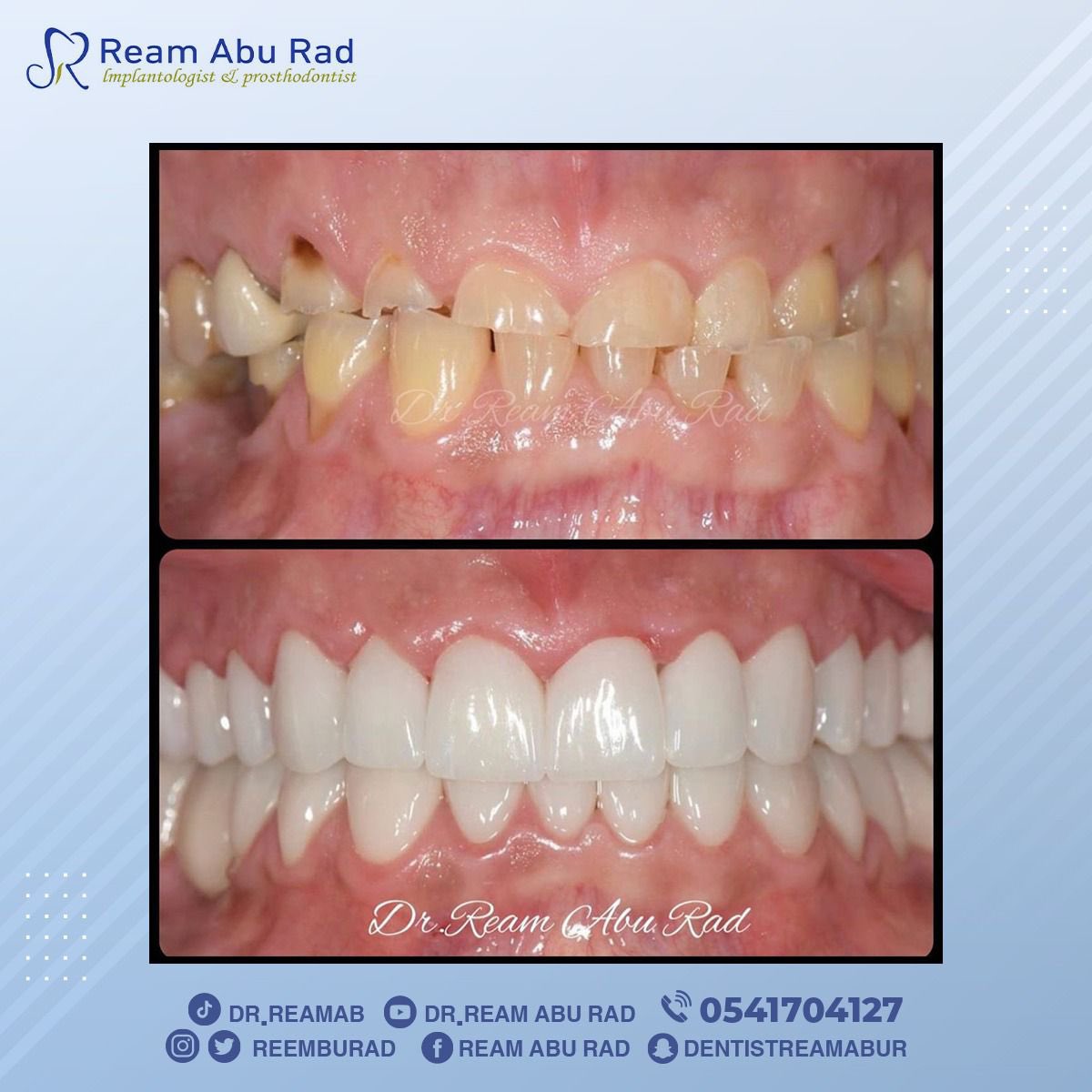 reemaburad's tweet photo. خلي ابتسامتك أجمل
بالقيام بالإجراء الأفضل
اختار دائماً ابتسامة هوليوود
 لتتمتع بالفرق🤩

.

#الخبر #تجميل #علاجات #زراعة #ابتسامة #قبل_بعد #صباح_الخير #الجبيل #الشرقية #الظهران #تابعني #موسم #قرقيعان #فولو #حفلات #هوليوود #وناسة #عروض #مكياج #الكورنيش #مسائي #كود_خصم #صباح_الخير https://t.co/kjP1eF6IO9
