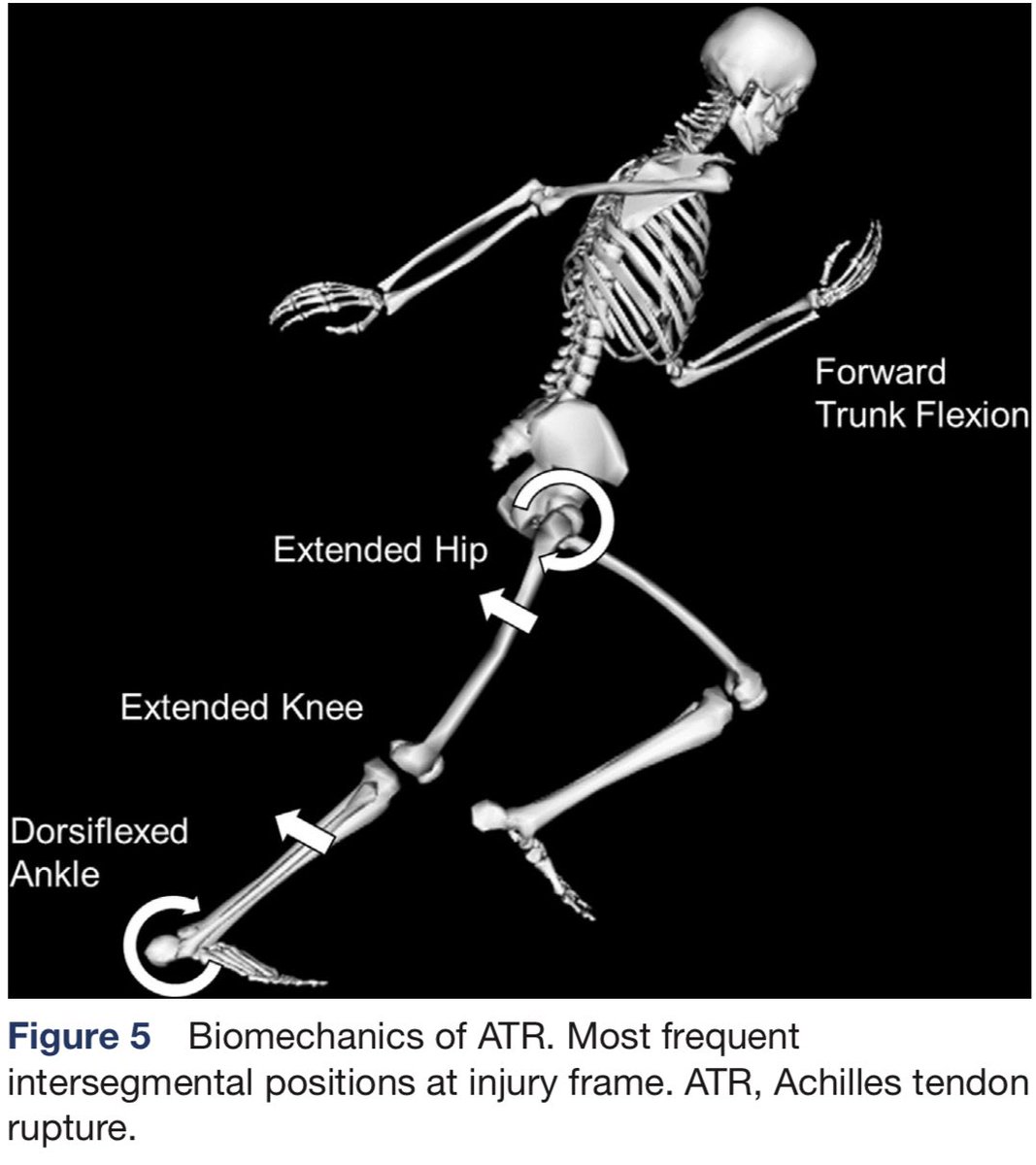 FDellaVilla's tweet photo. Our study on video analysis of Achilles Tendon Ruptures in football players is online @BMJOpenSEM 
- 60 injuries
- 83% pure non contact injuries
- Mostly accelerations injuries 
- 3 main patterns 
- Consistent biomechanics 

https://t.co/4YqvcNIYoJ

#achillestendon https://t.co/uvZImT9BxE