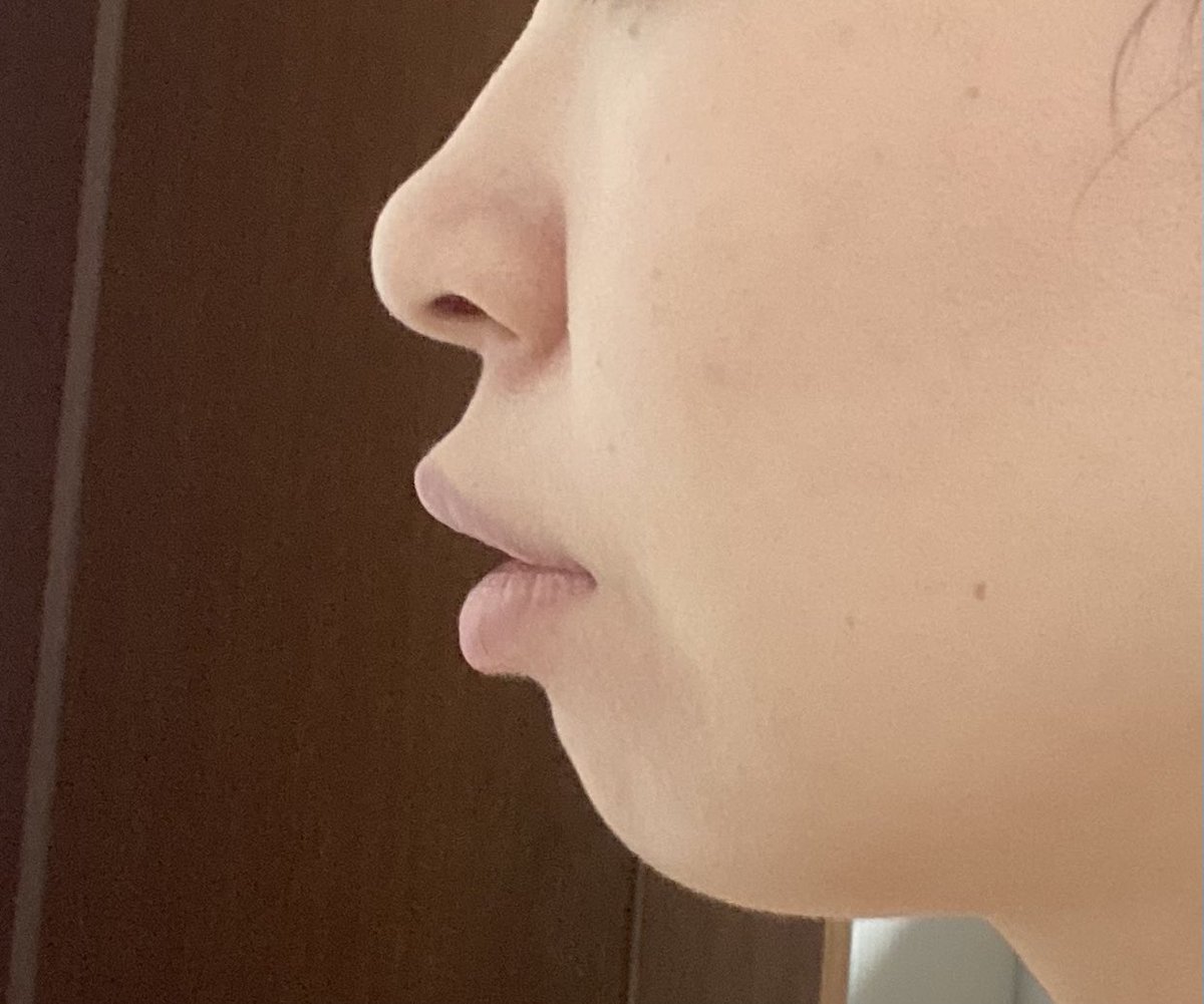 tearai2022's tweet photo. #歯列矯正
#矯正プロフィール

種類：マウスピース
費用：約140万円＋二ヶ月ごとの調整料5500円、検査費用約35000、着手金20万、抜歯4本約20000円)
開始：2022.9〜
期間：1年半年予定
悩み：口ゴボ、顎なし
抜歯：上左4番、右5番済、下左右4番(親知らず2本抜歯済み)

21時間装着を頑張るぞ〜 https://t.co/0A2mhfNVTe