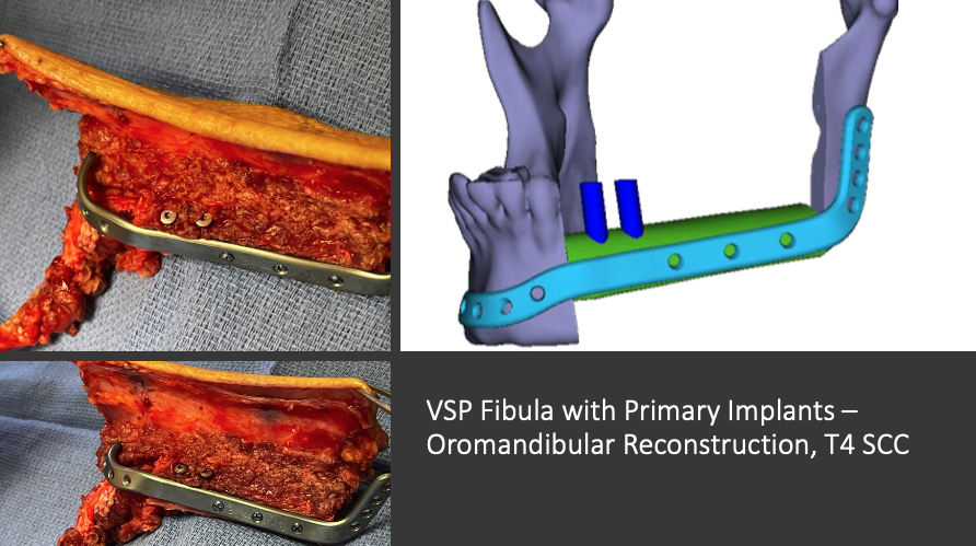 MarkKubikMD's tweet photo. This was the case of the week. Great collaboration with our oral surgery colleagues at Pitt. Primary implants are essential to dental rehabilitation in the case of required adjuvant radiation.  @PittHeadAndNeck https://t.co/lRDLIuDzjL