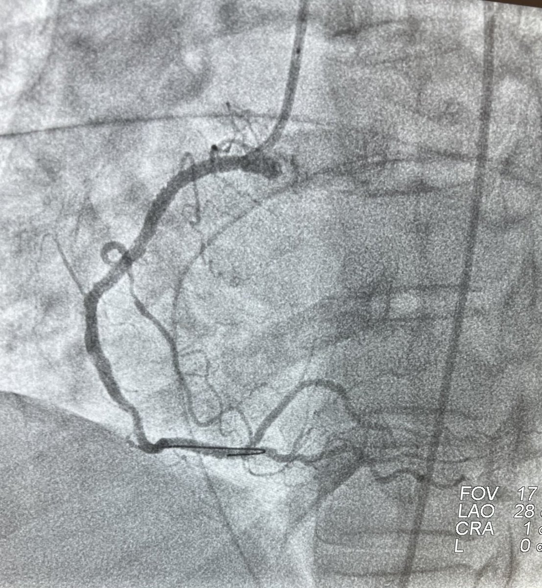 Early morning inferior STEMI. Congrats <a href="/SnehaSharmaDO/">Sneha Sharma</a> on a great finish to your first week of nights as an OSU Cardiology Fellow! 🫀🫶<a href="/RameshEmani/">Ramesh Emani</a> <a href="/Gumina_Lab/">Gumina Lab</a> @OSUCVMFellows