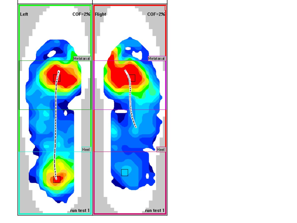 Docorange1's tweet photo. #pressuremapping force vs time curves and CoP can provide tremendous information for why the foots motions may be stopping, delayed, or reversing direction during contact. Mitigation of these delays can increase performance for your athletes. https://t.co/XlZL7cj8VC