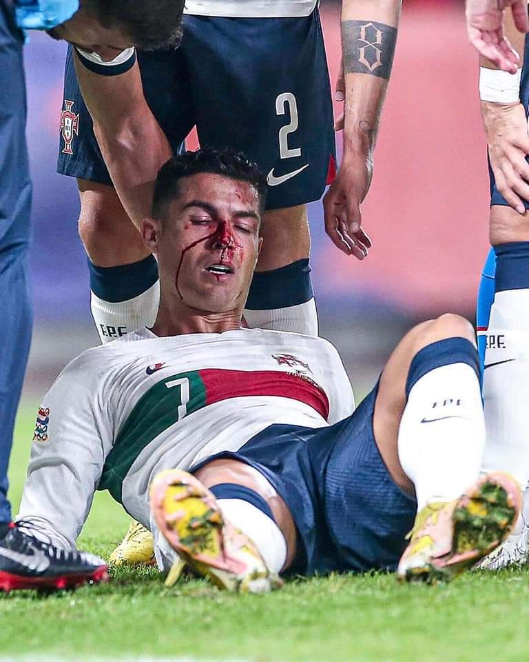 Jaison815's tweet photo. #dedicationlevel🔥🔥 Played with Bleeding Nose
#Cristiano #CR7𓃵 @Cristiano #PortugalvsCzech #UEFANationsLeague⚽⚽⚽ @ChampionsLeague @EURO2024 @ManUtd @premierleague https://t.co/Pw1JjCr1pp