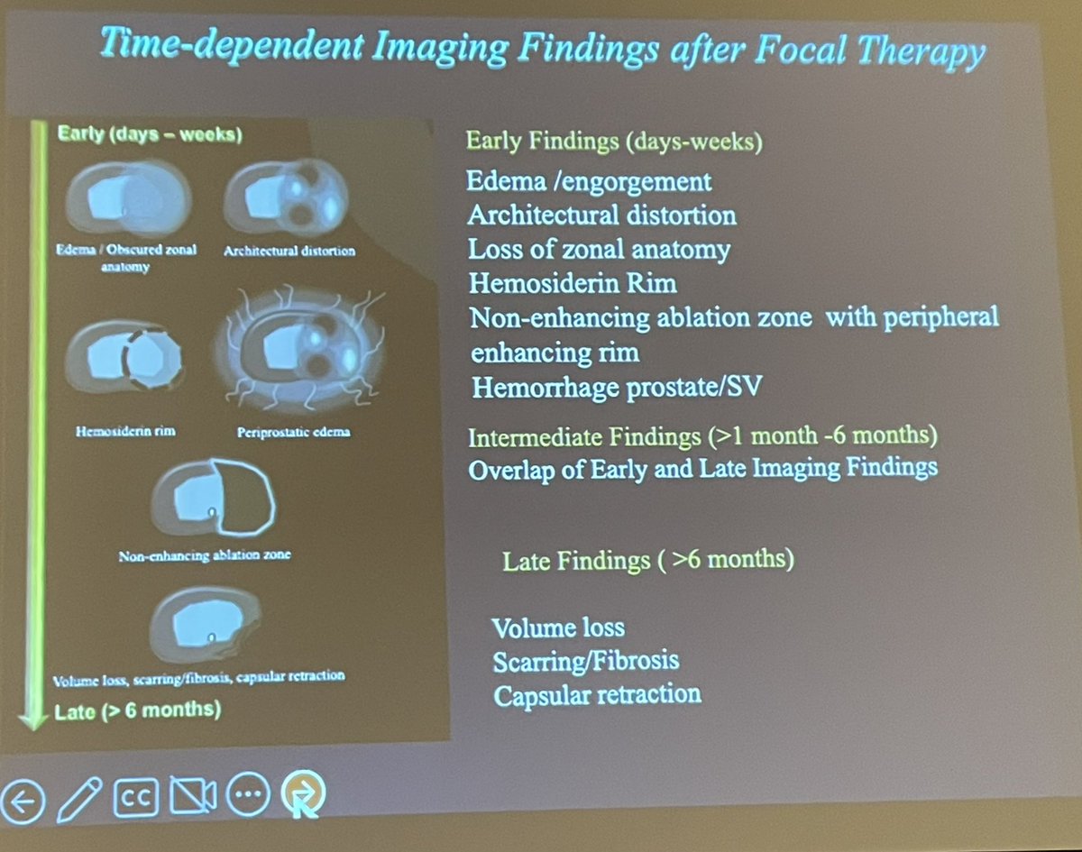Arvin K. George, MD (@arvinkgeorge) on Twitter photo <a href="/VermaSadhna/">Sadhna Verma MD, FSAR</a> reviews post-ablation imaging findings.
<a href="/SAR_ProstateDFP/">SAR Prostate DFP</a>
<a href="/AbhinavSidana/">Abhinav Sidana</a> <a href="/CincyUrology/">Cincy Urology</a>
#FOCAL22 <a href="/VermaSadhna/">Sadhna Verma MD, FSAR</a> reviews post-ablation imaging findings.
<a href="/SAR_ProstateDFP/">SAR Prostate DFP</a>
<a href="/AbhinavSidana/">Abhinav Sidana</a> <a href="/CincyUrology/">Cincy Urology</a>
#FOCAL22