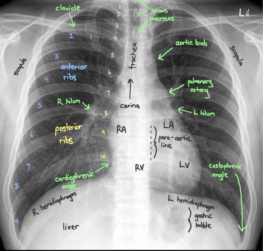 BrownJHM's tweet photo. Chest X-ray interpretation @rishikumarmd #BJHM #MedEd #Medtwitter https://t.co/jvSgKyHdhk