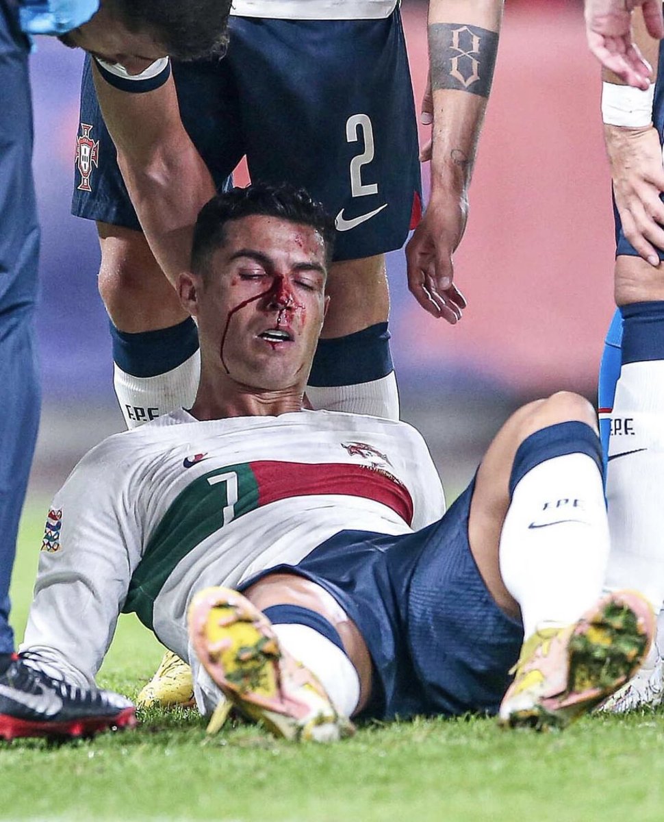 FrankKhalidUK's tweet photo. I hope Cristiano Ronaldo is ok, looks a nasty injury to his face. He sustained the injury while playing for Portugal. 🇵🇹 https://t.co/RaZbfy5Dku