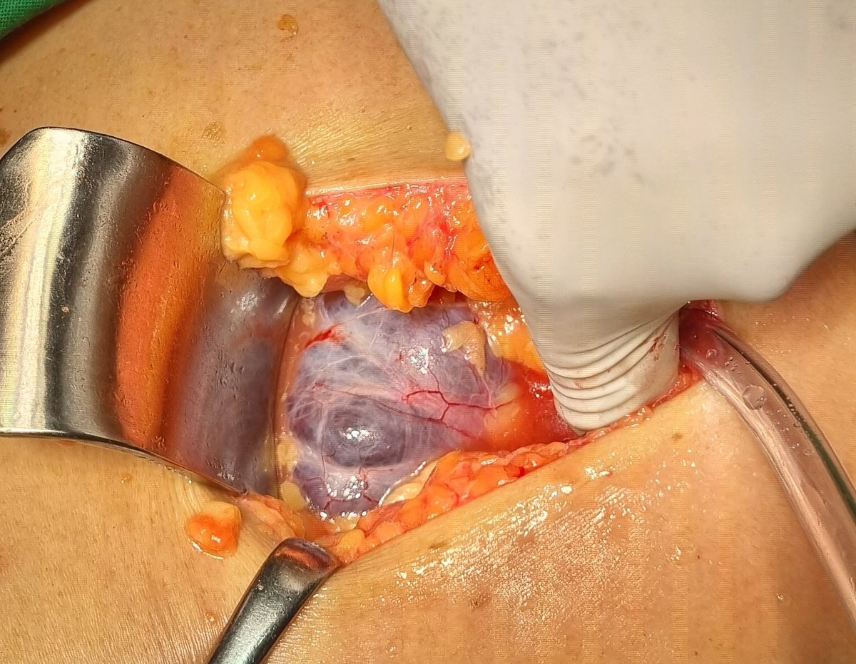 Bismillaah.. 
Kapan varikokel dioperasi ?
Sering dengar penyakit varikokel kan ? Yaitu pelebaran ven...