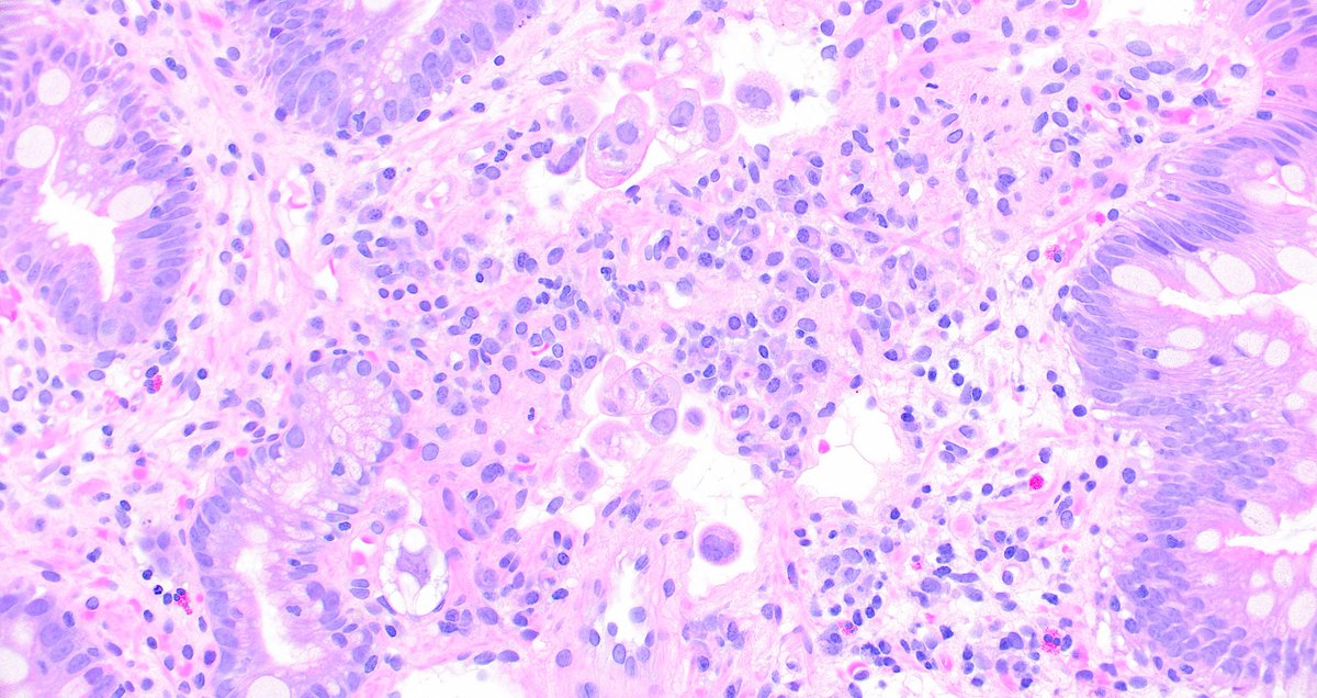 Duodenal biopsy with carcinoma in dilated lymphatics. It can be sneaky! Photos by <a href="/JBirkness/">Jackie Birkness-Gartman</a> #PathTwitter #pathology #GIpath