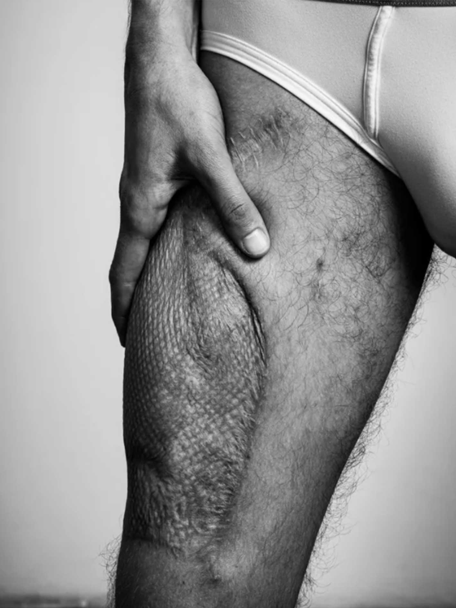 MamelaFialloFlo's tweet photo. Una ideología que aplaude si una mujer se amputa los senos sanos y se saca un pedazo de la pierna para crear un falso pene flácido, para parecer (nunca será) hombre, no defiende a la mujer.
La vulnera y conduce a despreciar su feminidad.
Hoy más que nunca #FemeninaSíFeministaNo https://t.co/YTwwFTdB7C