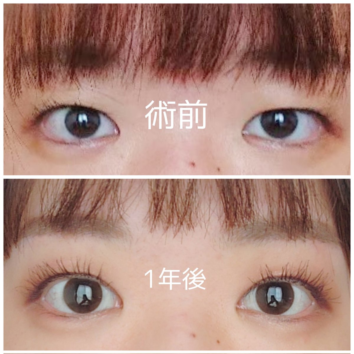 m_oilqq's tweet photo. 眉下切開と目頭切開　経過
1年💮
もうほぼ変化ないのでメイクした状態のビフォアフを。
傷はもちろんコンシーラーなしです。
整形したこと記憶にないぐらい何も気にならない🤙
素カメラで友達と写真撮ることが増えました。
もう経過写真は載せないと思いますが何か質問とかあれば質問箱にどうぞ🙏🏻 https://t.co/qRLbZwjqD1