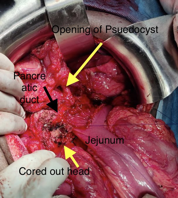 Freys procedure with inclusion of upper border after opening of Psuedocyst in to anastomosis was done