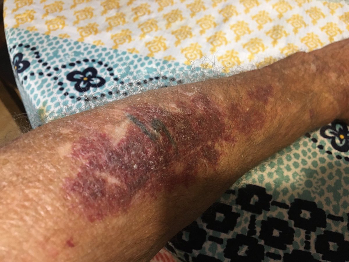 CharlesAtsila's tweet photo. This was not on my arm when I laid down to try and sleep. Not much sleep, just toss and turn. This morning I noticed my arm was itching and looked down. This is what I see. I’ve seen Dr, before. They take blood and say they find no reason for it. I damn sure know what it is https://t.co/LxJzw7W11t