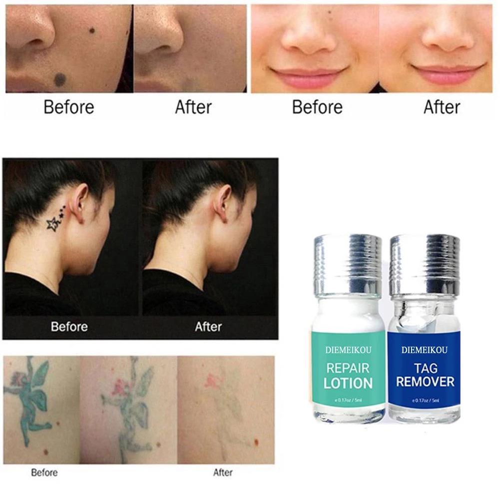 HarrisOs0's tweet photo. Tattoo removal available in stock only K13000 https://t.co/nYfz91dtGL