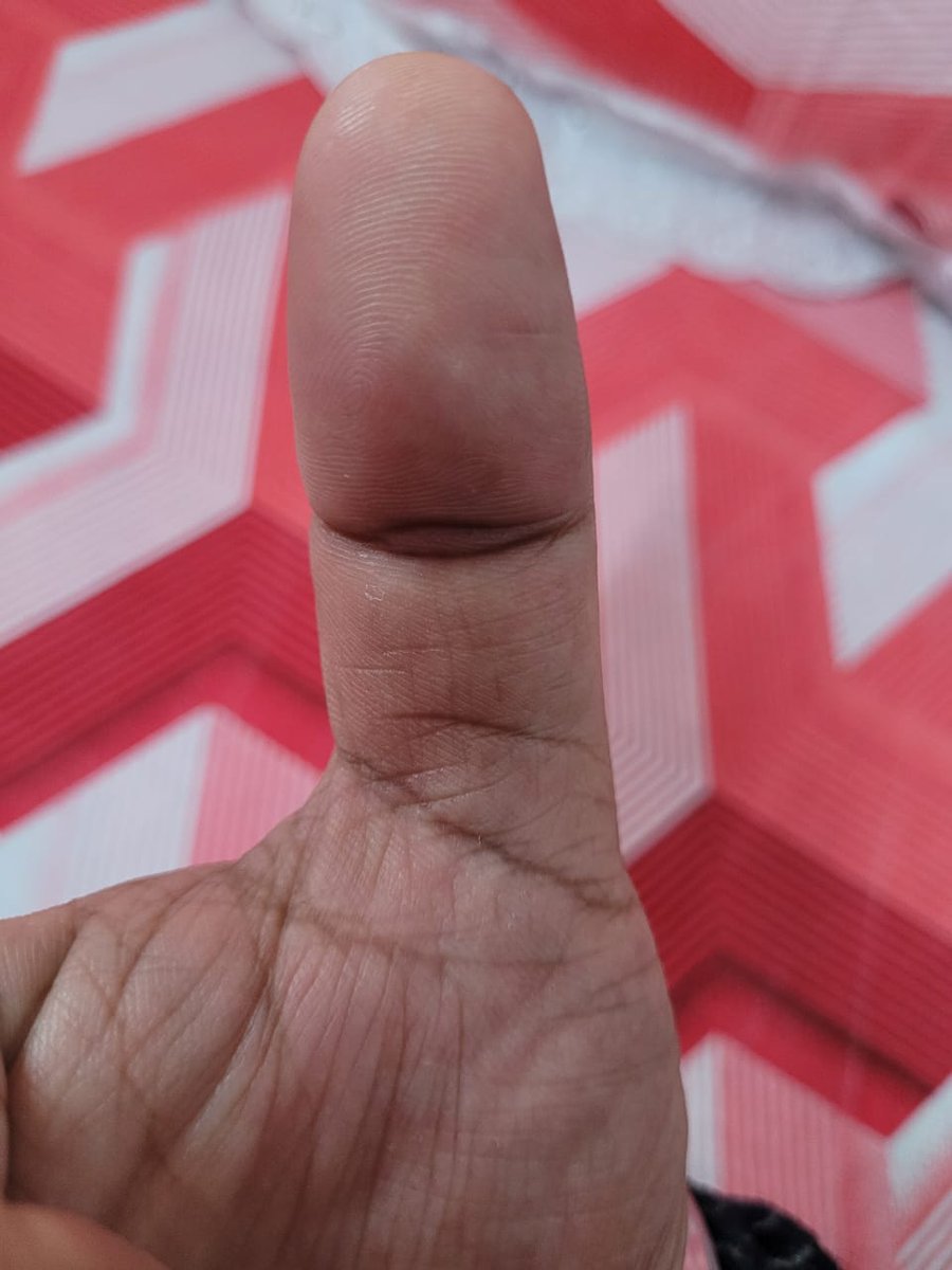 Wealth Indicator in Palmistry
PHOENIX EYE on THUMB
If you see such similar sign on one thumb even better if it's in both.
Most effective if present in your Active dominant hand.
Then the native will never face lack of money in his whole life.
#astrology
#palmistry
#astrologer