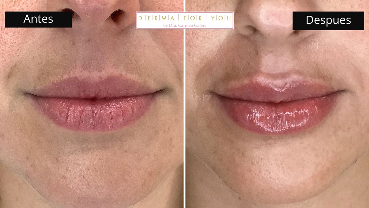 Dermaforyou's tweet photo. Nuestra paciente está luchando contra el #acné y las marcas. A raïz de los ttos me pidió hidratación y volumen labial. Lo realicé con #volift.
Un labio hidratado y bonito nos gusta a todos ¿verdad?
#Dermaforyou #DraCarmenGalera
https://t.co/ZJFhFJLwjd https://t.co/BoZbqK7dVH