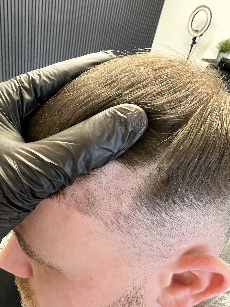 scalprenovation's tweet image. 🖊Before and After on this scar🖊

#SMP
#SCALPMICROPIGMENTATION
#SCALPPIGMENTATION
#SCLAPRENOVATION
#UKBARBER
#MENSHAIR
#HAIRLOSS
#HAIRLOSSTREATMENT 
#HAIRLOSSISTOSS
#MALEPATTERNBALDNESS
#ALOPECIA 
#HAIRTATTOO
#HAIRLOSSTATTOO
