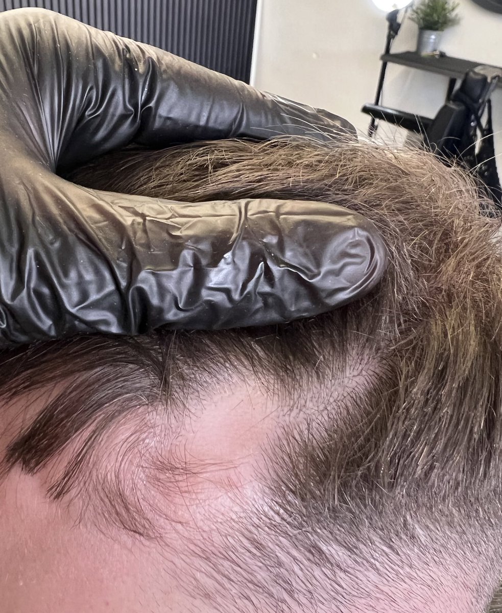 scalprenovation's tweet image. 🖊Before and After on this scar🖊

#SMP
#SCALPMICROPIGMENTATION
#SCALPPIGMENTATION
#SCLAPRENOVATION
#UKBARBER
#MENSHAIR
#HAIRLOSS
#HAIRLOSSTREATMENT 
#HAIRLOSSISTOSS
#MALEPATTERNBALDNESS
#ALOPECIA 
#HAIRTATTOO
#HAIRLOSSTATTOO