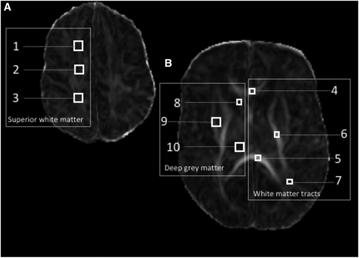 Sheng et al evaluated the relationship of quantitative ventricular volume with brain maturation and neurodevelopmental outcomes at age 4.5 years in children born very preterm. bit.ly/3ffPK7a