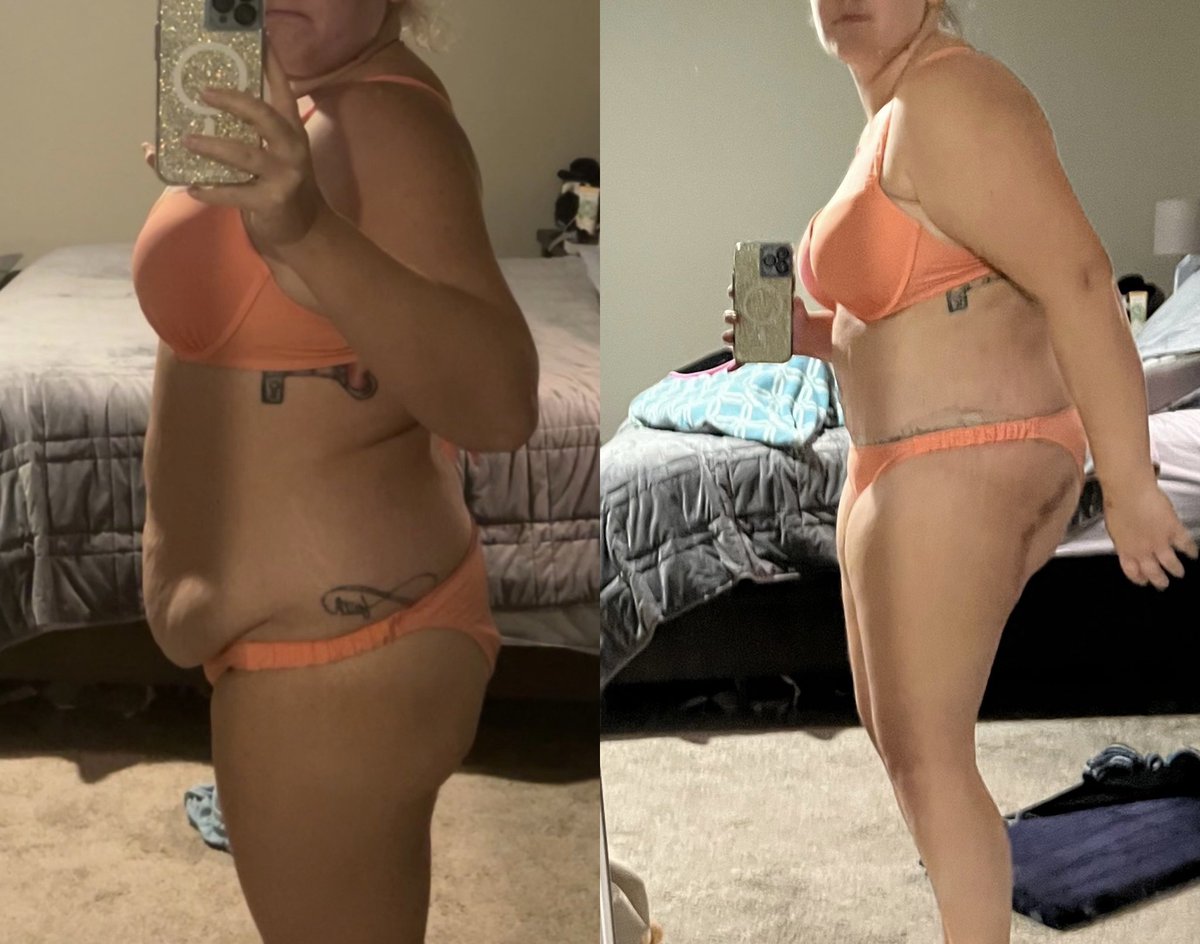 Houston_RN's tweet photo. Guys I did a thing. In 2012 I realized I needed to lose weight. I was weighing in at 304lbs and decided it was time to lose weight. Over the course of a decade I lost down to 175lbs and kept it off in between my 2 kids. On 9/15 I finally did something for me. 7lbs skin 5L fat 🥹 https://t.co/BPKiWTUOpY