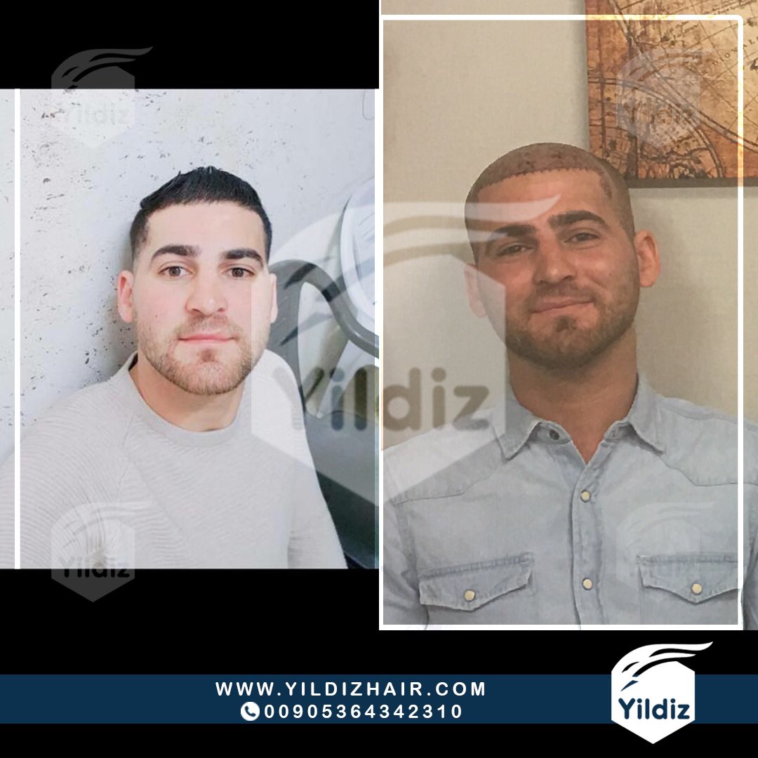 3 ايام #فقط لاتمام #زراعة_الشعر
#زراعة_الشعر_في_تركيا 🇹🇷 >> جدد حياتك معنا 💫
فريق إستشار طبي مختص للإجابة على إستفسارتكم على مدار الساعة #زراعة_الشعر #زراعة_الذقن
إتصل الآن:  00905364342310  📲📩 -
yildizhair.com ✅