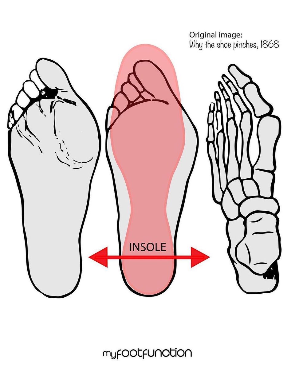 feelgrounds's tweet photo. “Why the shoe pinches, published 1868. This incredible book was published to help educate the public over 150 years ago. We have highlighted some of the pages surrounding this “famous” illustration which we have attempted to bring back to life.” - @myfootfunction #feelgrounds https://t.co/sRod5QwSEt
