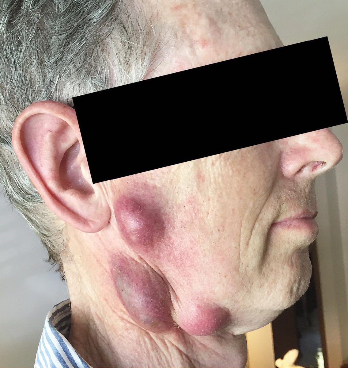 AvrahamCooperMD's tweet photo. Glandular tularemia (2nd most common form of the disease after ulceroglandular) ⬇️

#MedTwitter https://t.co/uw5i6kra0t