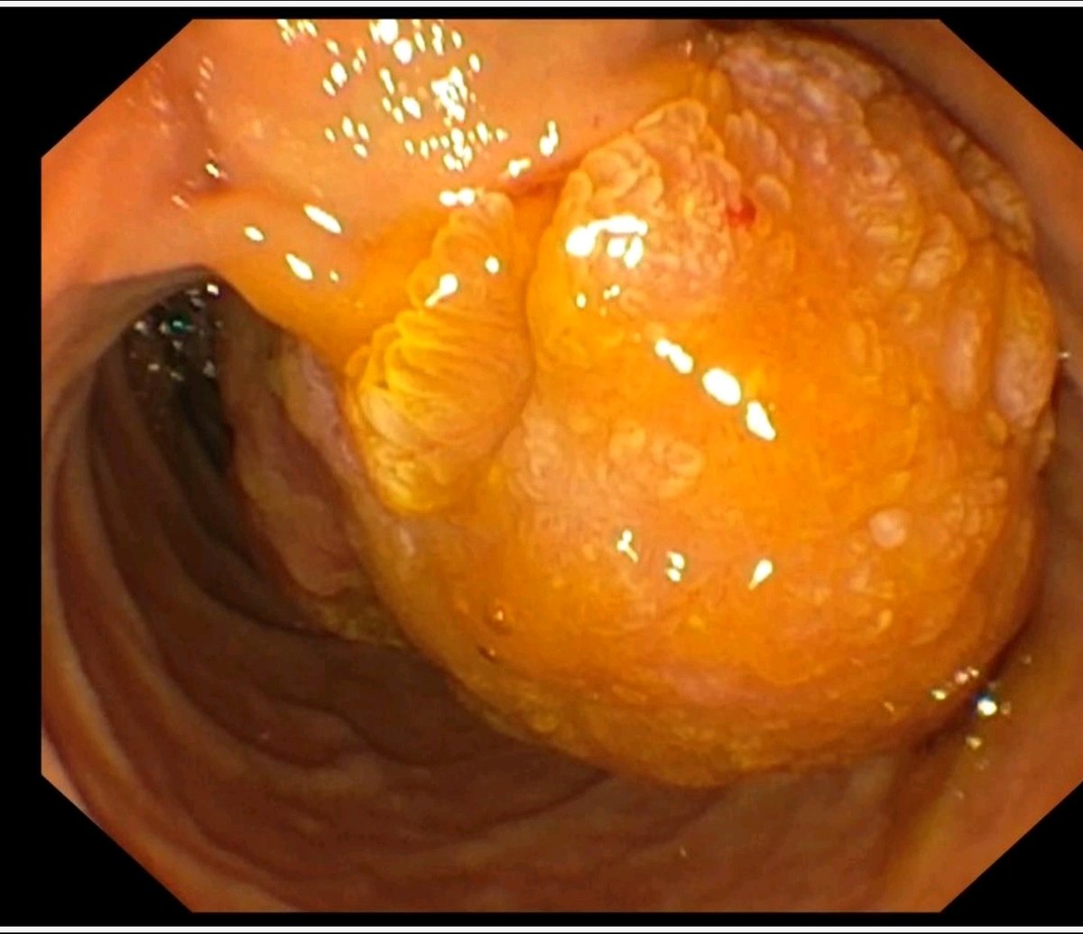 SahajRathi's tweet photo. 65/F
Jaundice x 1m
Fever w chills x 4d

Bil: 6.7mg/dl

USG: grossly dilated CBD till distal end

MRCP: 2.5x5 cm periamp lesion

ERCP: Large lesion- Scope not negotiable past the lesion. Biliary orifice not visible

EUS: m. propria not breached. Large feeder

WDYD #GITwitter? https://t.co/Y8wrZWUXvp